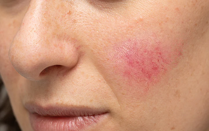 skin-infections-in-prabhadevi